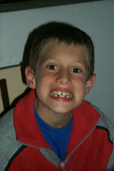 Gaetan with two teeth out